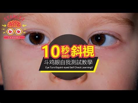 幼兒斜眼看人|斜視：成因、病徵及治療 